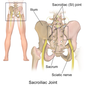 Sciatica