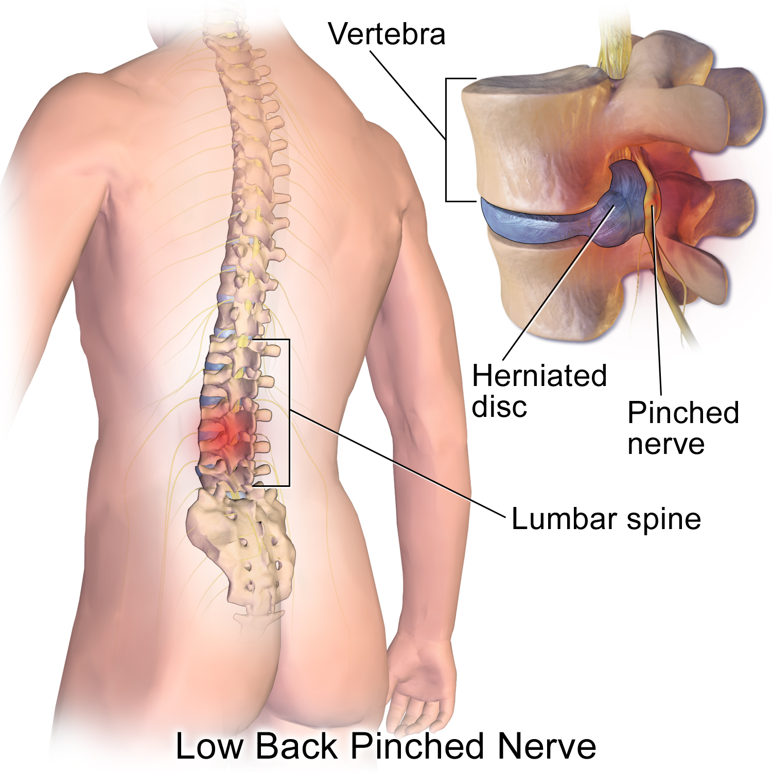 bulging disc - bye bye lower back pain
