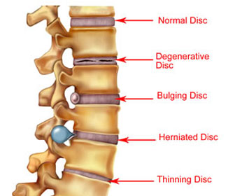 Bulging Disc